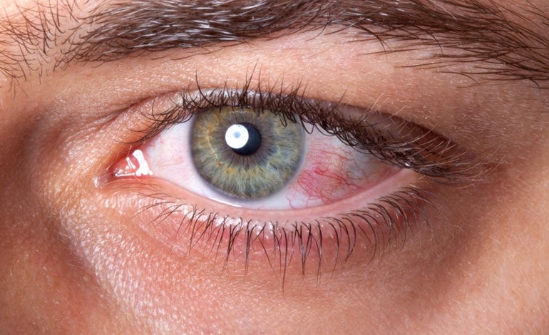 Zespół suchego oka – co to jest? Przyczyny, objawy i leczenie.